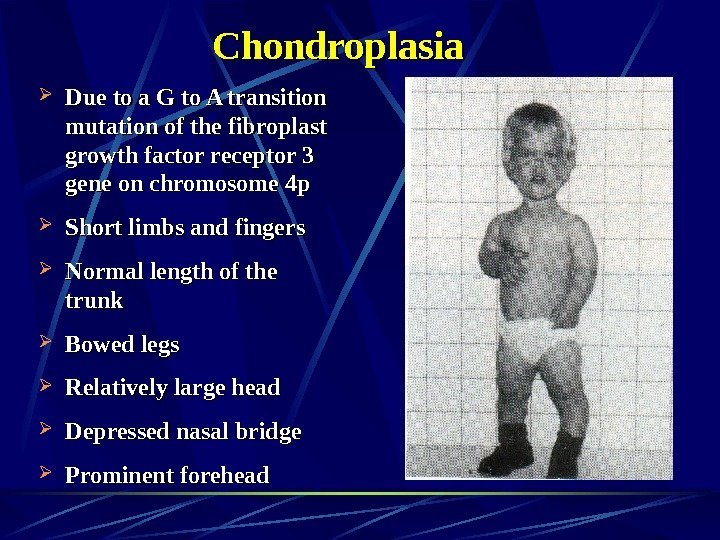   Chondroplasia Due to a G to A transition mutation of the fibroplast