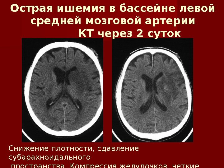 Очаг ишемии мозга. Ишемический инсульт кт. Ишемический инсульт в бассейне левой средней мозговой артерии. ОНМК В бассейне левой средней мозговой. Ишемический инсульт левой средней мозговой артерии поражения.