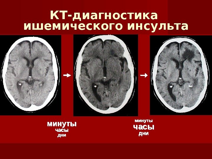 Что такое ишемический инсульт головного мозга. Периоды ОНМК по мрт. Ишемический инсульт морфология. Стадии ОНМК по плотности. Постинфарктные изменения головного мозга.
