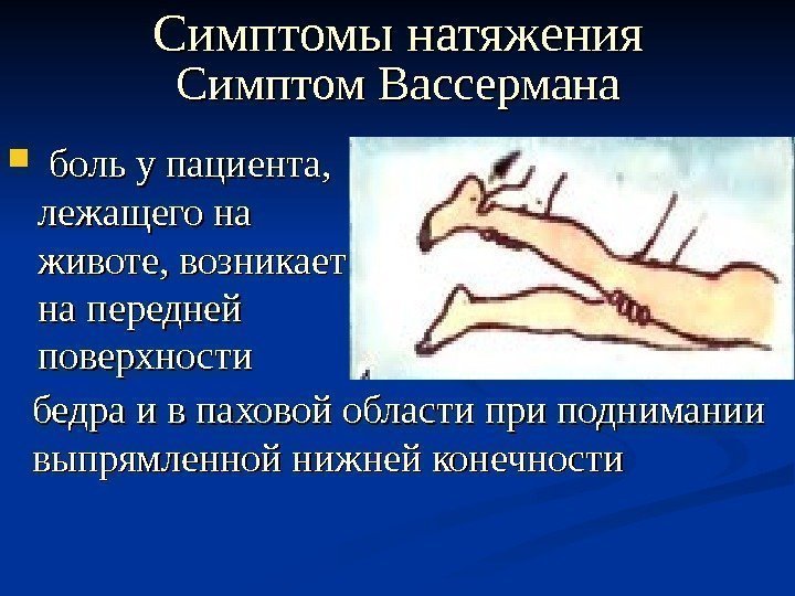 Симптом Вассермана боль у пациента,  лежащего на животе, возникает на передней поверхности Симптомы