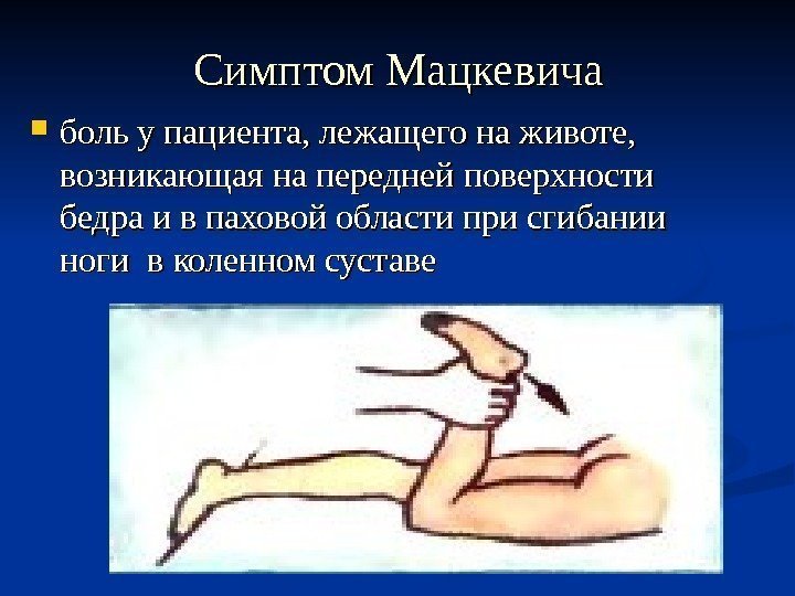 Симптом Мацкевича боль у пациента, лежащего на животе,  возникающая на передней поверхности бедра
