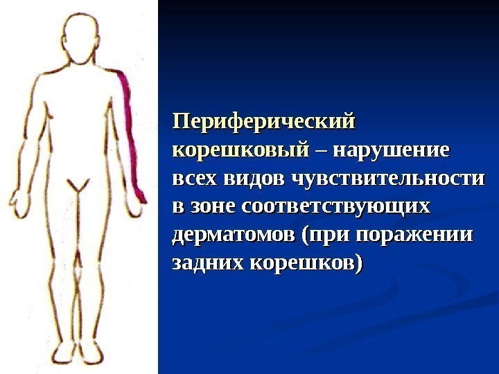 Периферический корешковый – нарушение всех видов чувствительности в зоне соответствующих дерматомов (при поражении задних
