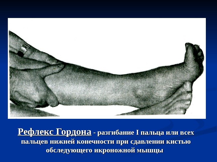 Рефлекс Гордона - разгибание II пальца или всех пальцев нижней конечности при сдавлении кистью