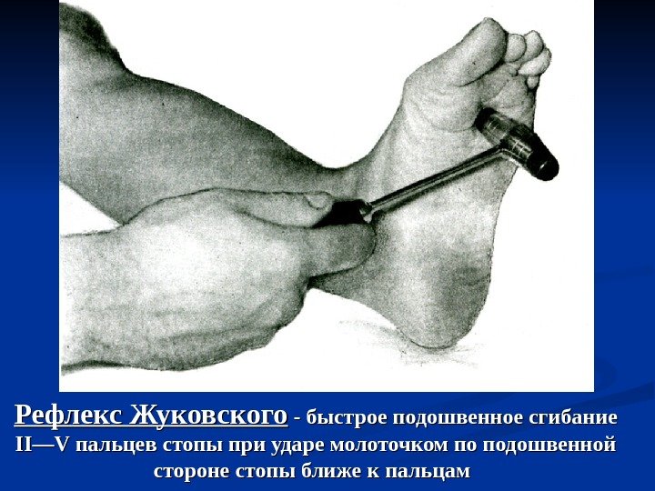 Рефлекс Жуковского - быстрое подошвенное сгибание IIII —— VV пальцев стопы при ударе молоточком
