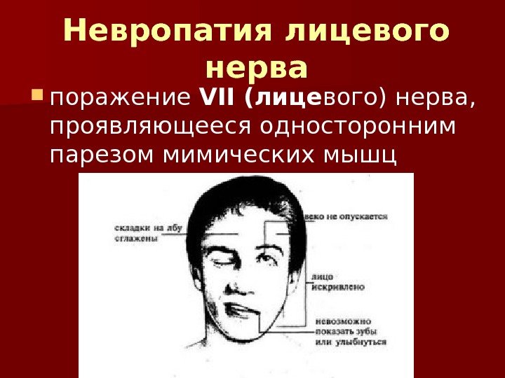 Невропатия лицевого нерва поражение VII (лице вого) нерва,  проявляющееся односторонним парезом мимических мышц