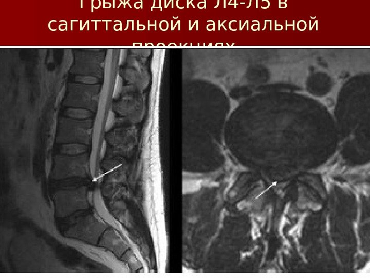 Грыжа диска Л 4 -Л 5 в сагиттальной и аксиальной проекциях 