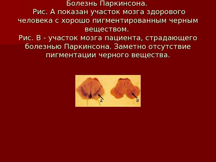 Болезнь Паркинсона.  Рис. А показан участок мозга здорового человека с хорошо пигментированным черным