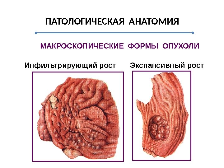 ПАТОЛОГИЧЕСКАЯ АНАТОМИЯ МАКРОСКОПИЧЕСКИЕ ФОРМЫ ОПУХОЛИ Инфильтрирующий рост Экспансивный рост 