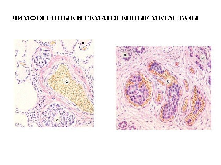 ЛИМФОГЕННЫЕ И ГЕМАТОГЕННЫЕ МЕТАСТАЗЫ 