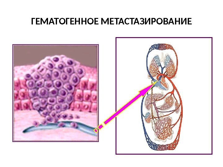 ГЕМАТОГЕННОЕ МЕТАСТАЗИРОВАНИЕ 