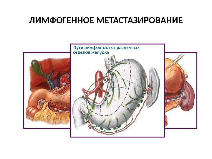 ЛИМФОГЕННОЕ МЕТАСТАЗИРОВАНИЕ РАСПРОСТРАНЕНИЕ ПО ЛИМФАТИЧЕСКОЙ СИСТЕМЕ 