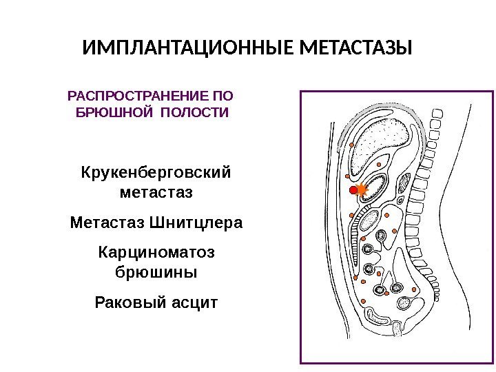 ИМПЛАНТАЦИОННЫЕ МЕТАСТАЗЫ РАСПРОСТРАНЕНИЕ ПО  БРЮШНОЙ ПОЛОСТИ Крукенберговский метастаз Метастаз Шнитцлера Карциноматоз брюшины Раковый