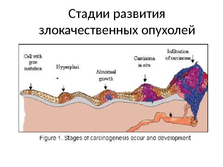 Стадии развития злокачественных опухолей 