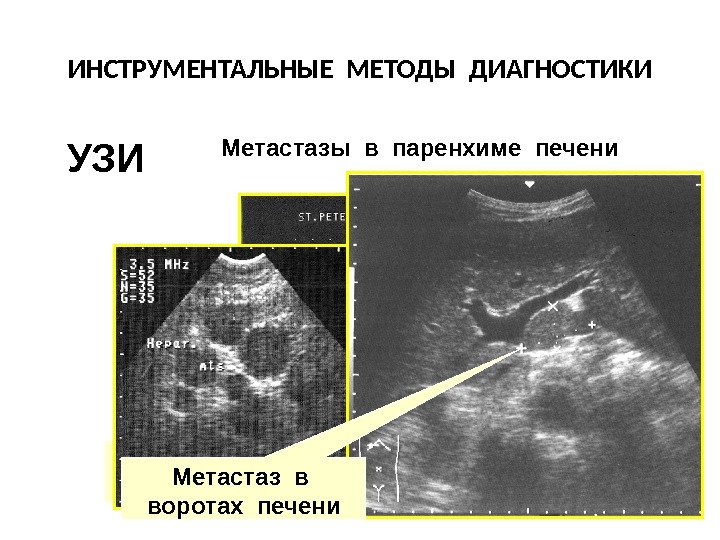 ИНСТРУМЕНТАЛЬНЫЕ МЕТОДЫ ДИАГНОСТИКИ УЛЬТРАЗВУКОВОЕ СКАНИРОВАНИЕ ПЕРВИЧНАЯ ОПУХОЛЬ (эндофитный рост) Метастазы в паренхиме печени Метастаз