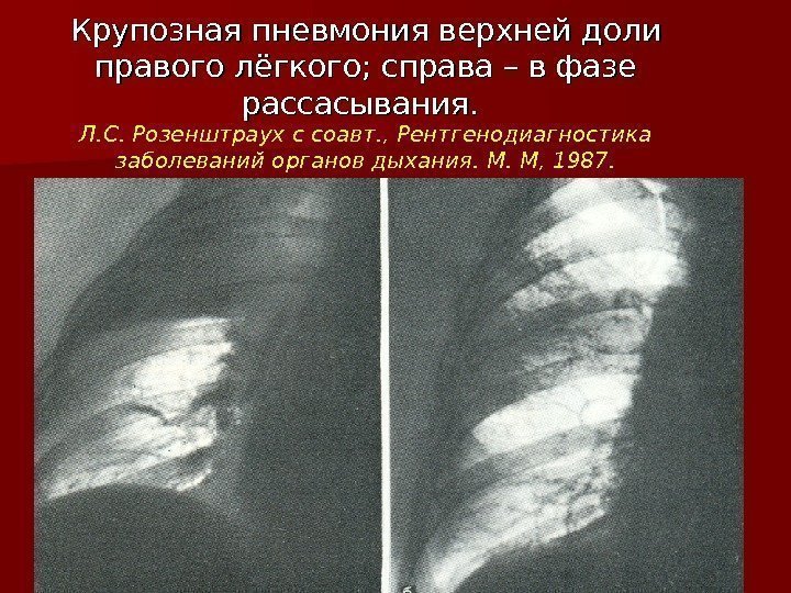 Крупозная пневмония верхней дол ии  правого лёгкого; справа – в фазе рассасывания. Л.
