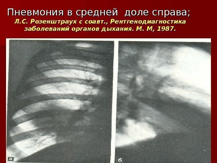 Пневмония в средней доле справа;  Л. С. Розенштраух с соавт. , Рентгенодиагностика заболеваний