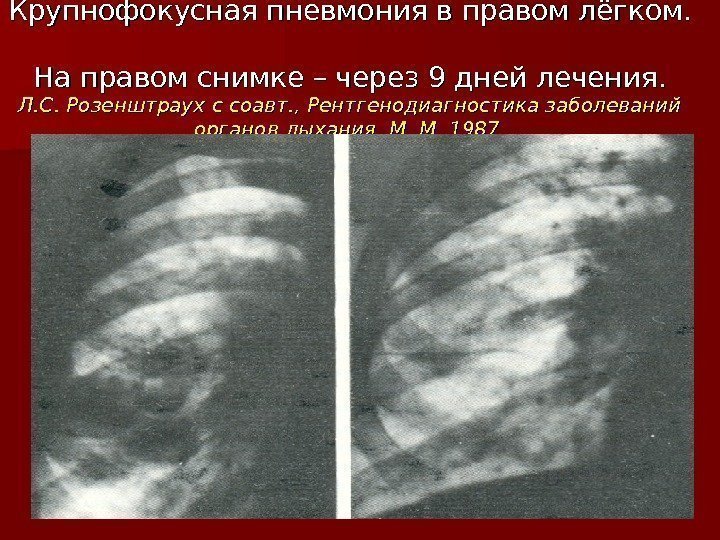 Крупнофокусная пневмония в правом лёгком.  На правом снимке – через 9 дней лечения.