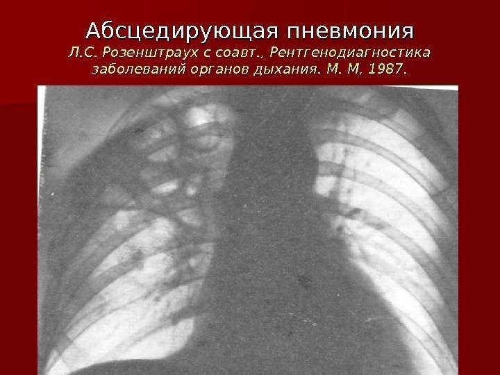 Абсцедирующая пневмония Л. С. Розенштраух с соавт. , Рентгенодиагностика заболеваний органов дыхания. М. М,