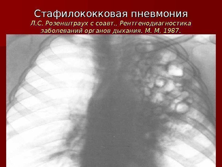 Стафилококковая пневмония Л. С. Розенштраух с соавт. , Рентгенодиагностика заболеваний органов дыхания. М. М,