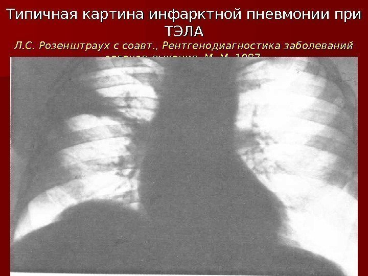 Типичная картина инфарктной пневмонии при ТЭЛА Л. С. Розенштраух с соавт. , Рентгенодиагностика заболеваний