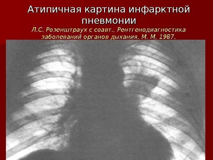 Атипичная картина инфарктной пневмонии Л. С. Розенштраух с соавт. , Рентгенодиагностика заболеваний органов дыхания.