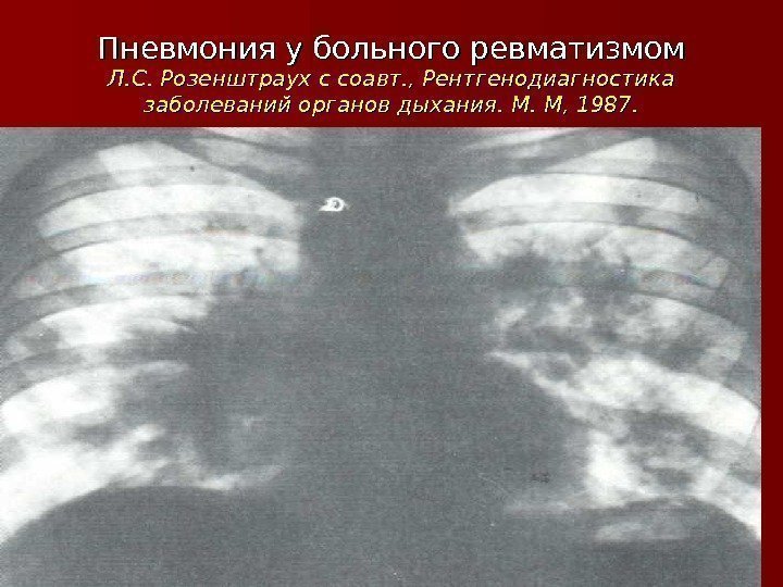 Пневмония у больного ревматизмом Л. С. Розенштраух с соавт. , Рентгенодиагностика заболеваний органов дыхания.