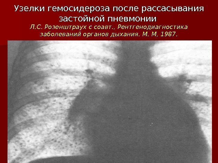 Узелки гемосидероза после рассасывания застойной пневмонии Л. С. Розенштраух с соавт. , Рентгенодиагностика заболеваний
