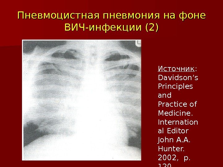 Пневмоцистная пневмония  на фоне ВИЧ-инфекции (2) Источник :  Davidson’s Principles and Practice