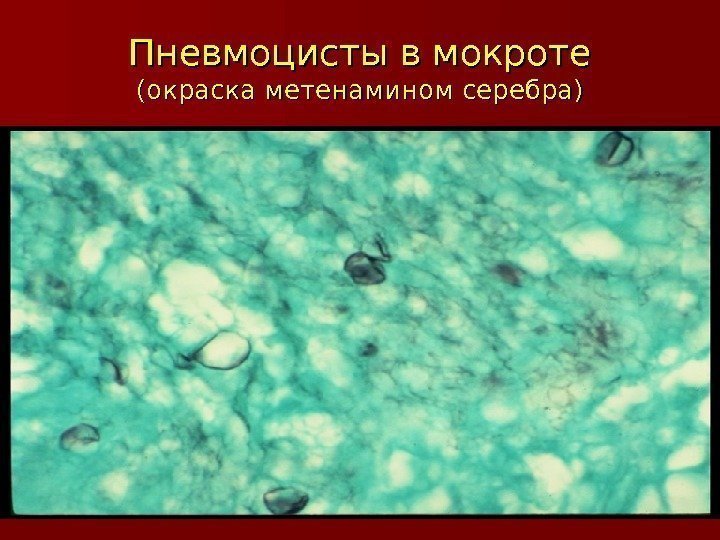 Пневмоцисты в мокроте (окраска метенамином серебра) 