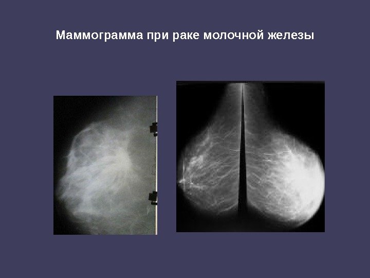 Маммограмма при раке молочной железы 