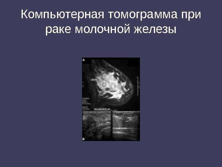 Компьютерная томограмма при раке молочной железы 
