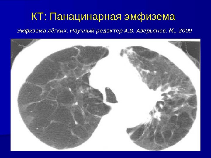 КТ: Панацинарная эмфизема  Эмфизема лёгких. Научный редактор А. В. Аверьянов. М. , 2009