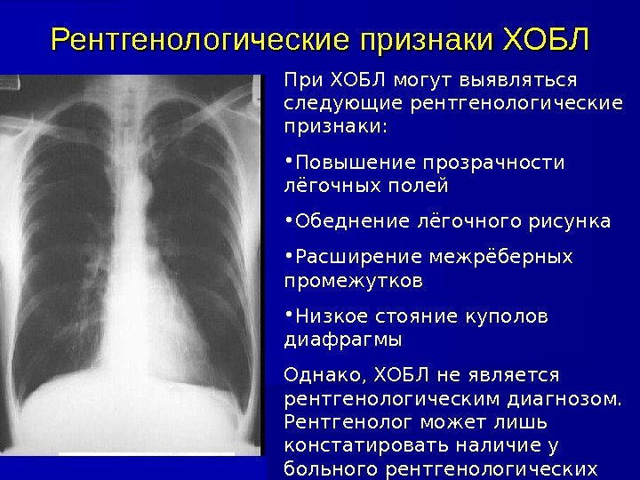 Рентгенологические признаки ХОБЛ При ХОБЛ могут выявляться следующие рентгенологические признаки:  • Повышение прозрачности