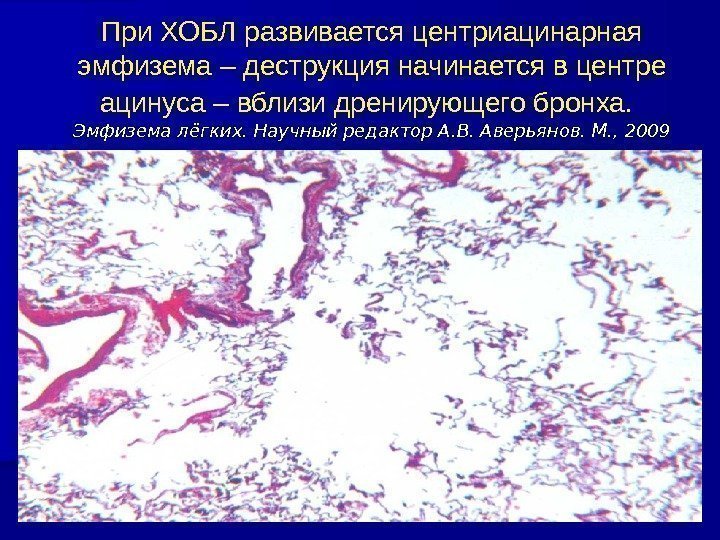 При ХОБЛ развивается центриацинарная эмфизема – деструкция начинается в центре ацинуса – вблизи дренирующего