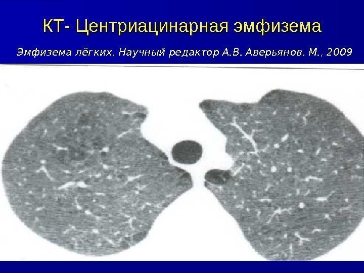 КТ- Центриацинарная эмфизема  Эмфизема лёгких. Научный редактор А. В. Аверьянов. М. , 2009