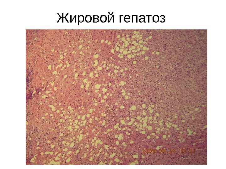 Жировой гепатоз 