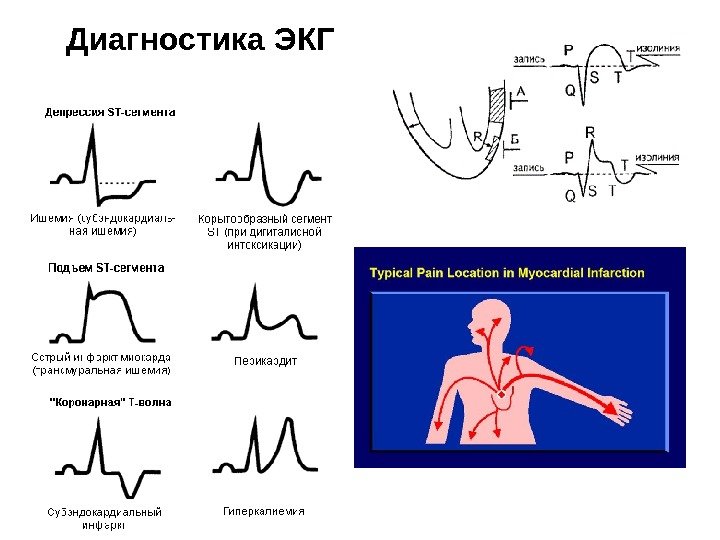   Диагностика ЭКГ 