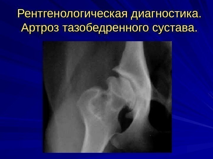 Рентгенологическая диагностика. Артроз тазобедренного сустава. 
