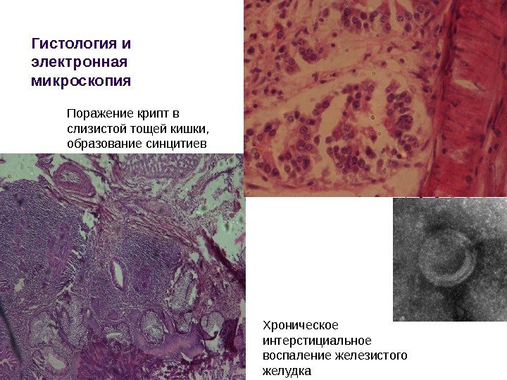 Гистология и электронная микроскопия Поражение крипт в слизистой тощей кишки,  образование синцитиев Хроническое