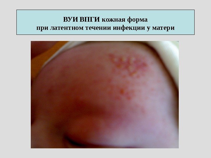 ВУИ ВПГИ кожная форма при латентном течении инфекции у матери  
