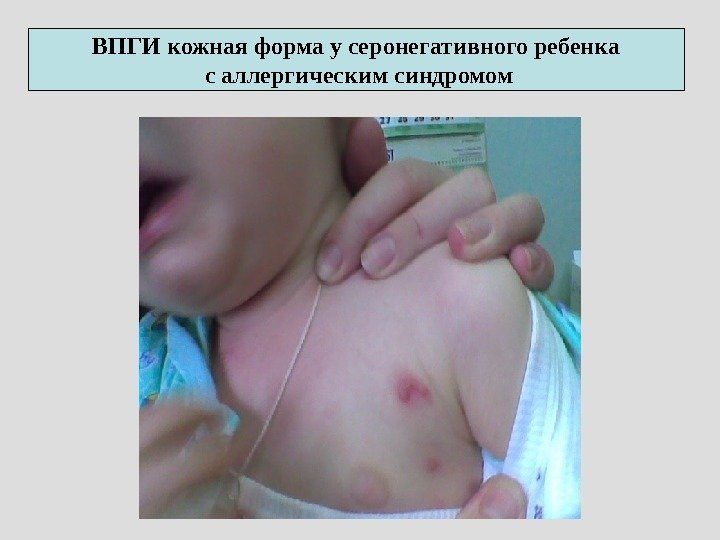 ВПГИ кожная форма у серонегативного ребенка с аллергическим синдромом 