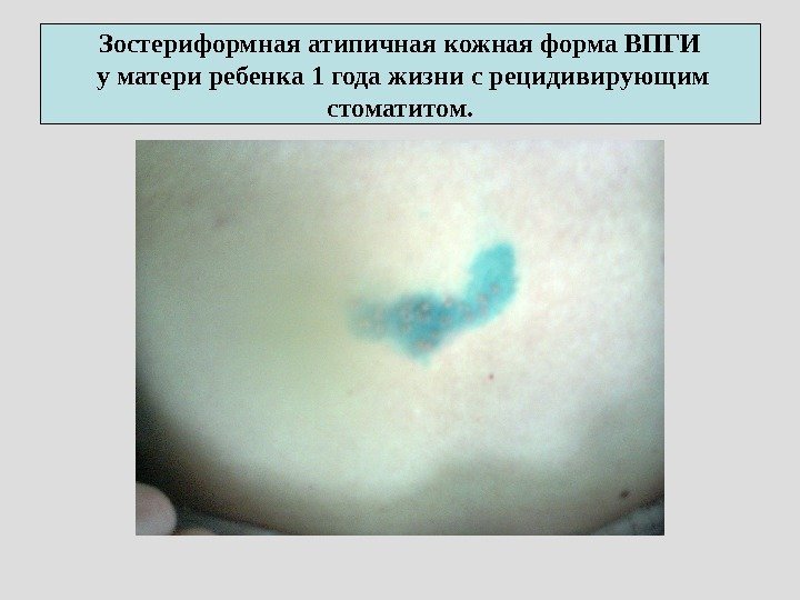 Зостериформная атипичная кожная форма ВПГИ у матери ребенка 1 года жизни с рецидивирующим стоматитом.