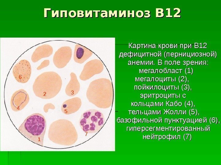   Гиповитаминоз В 12  Картина крови при В 12 дефицитной (пернициозной) анемии.