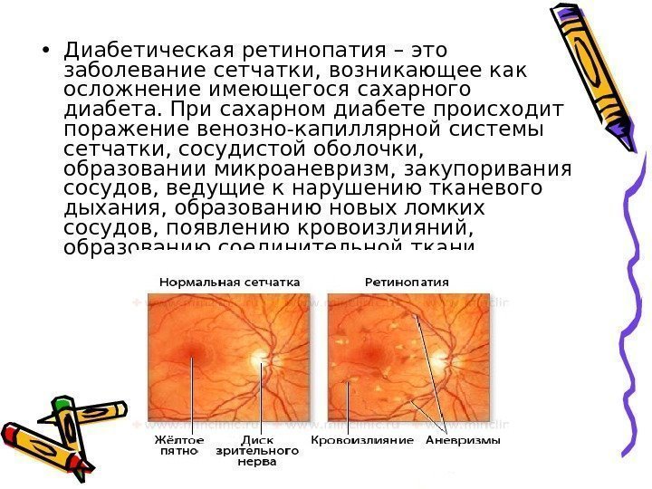  • Диабетическая ретинопатия – это заболевание сетчатки, возникающее как осложнение имеющегося сахарного диабета.