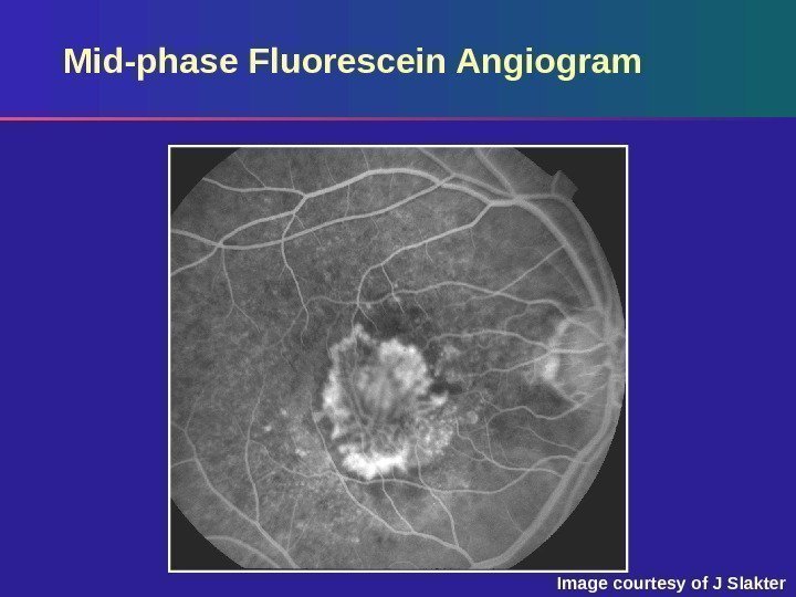 Mid-phase Fluorescein Angiogram Image courtesy of J Slakter 