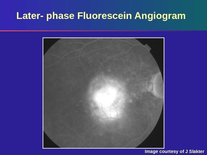 Later- phase Fluorescein Angiogram Image courtesy of J Slakter 