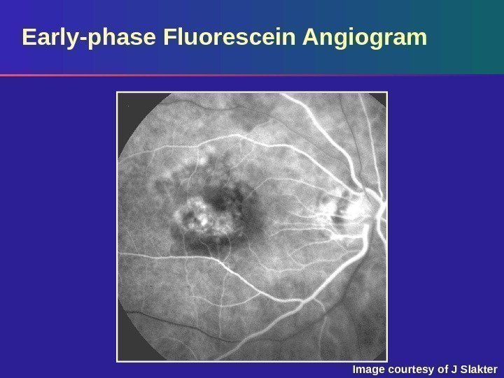 Early-phase Fluorescein Angiogram Image courtesy of J Slakter 