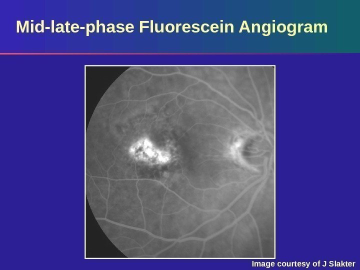 Mid-late-phase Fluorescein Angiogram Image courtesy of J Slakter 