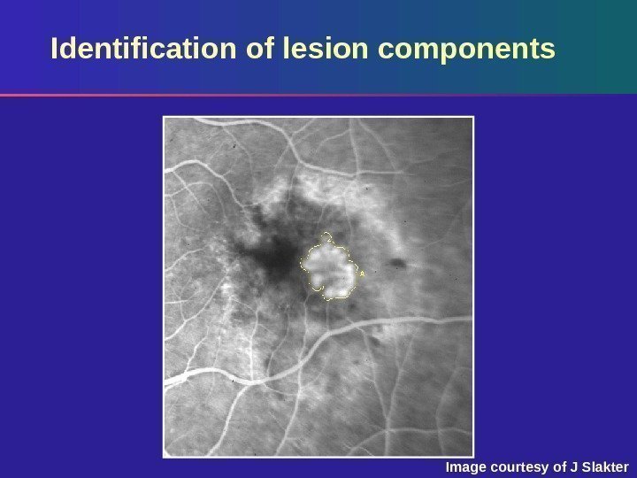 Identification of lesion components Image courtesy of J Slakter 