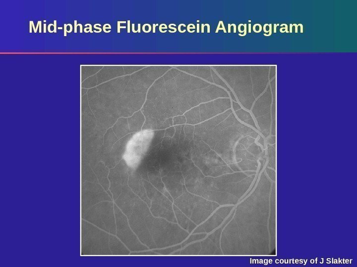 Mid-phase Fluorescein Angiogram Image courtesy of J Slakter 